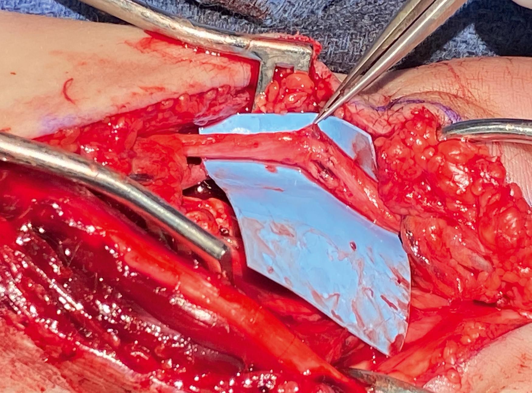 Fig. 30.10, Distal ulnar nerve with fascicular groups isolated and separately repaired.