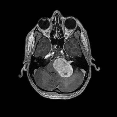 Fig 1, Schwannoma. MRI shows an enhancing cerebellopontine angle tumor with extension into the internal auditory meatus.