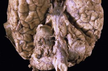 Fig 2, Schwannoma. This inferior view of the brain shows a large solid tumor ( left ) compressing the brain stem at the cerebellopontine angle.