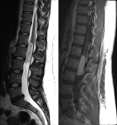 Fig 3, Schwannoma. These MRI images show a circumscribed neoplasm of the lumbar spinal cord.