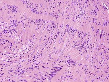 Fig 4, Schwannoma. Spindle cell Antoni A areas of a schwannoma with nuclear palisading.