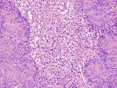 Fig 5, Schwannoma. Classic Antoni B histology consists of microcystic or vacuolated areas ( center of image ).