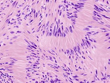 Fig 6, Schwannoma. Verocay bodies consist of palisaded tumor cell nuclei and areas of tumor that are devoid of nuclei.