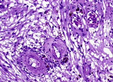 Fig 7, Schwannoma. This Antoni B area contains hyalinized blood vessels and perivascular hemosiderin.