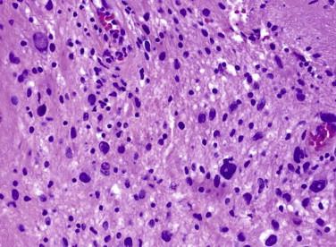 Fig 8, Schwannoma. Random nuclear and cellular atypia (“ancient change”) may be prominent in some tumors.