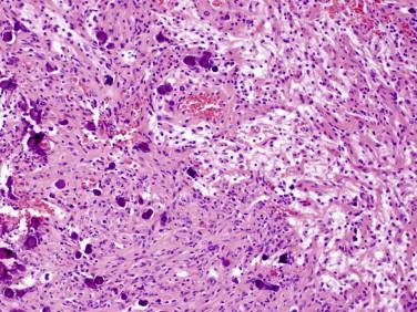 Fig 10, Psammomatous schwannoma. This rare neoplasm contains psammomatous calcifications and is associated with Carney complex.