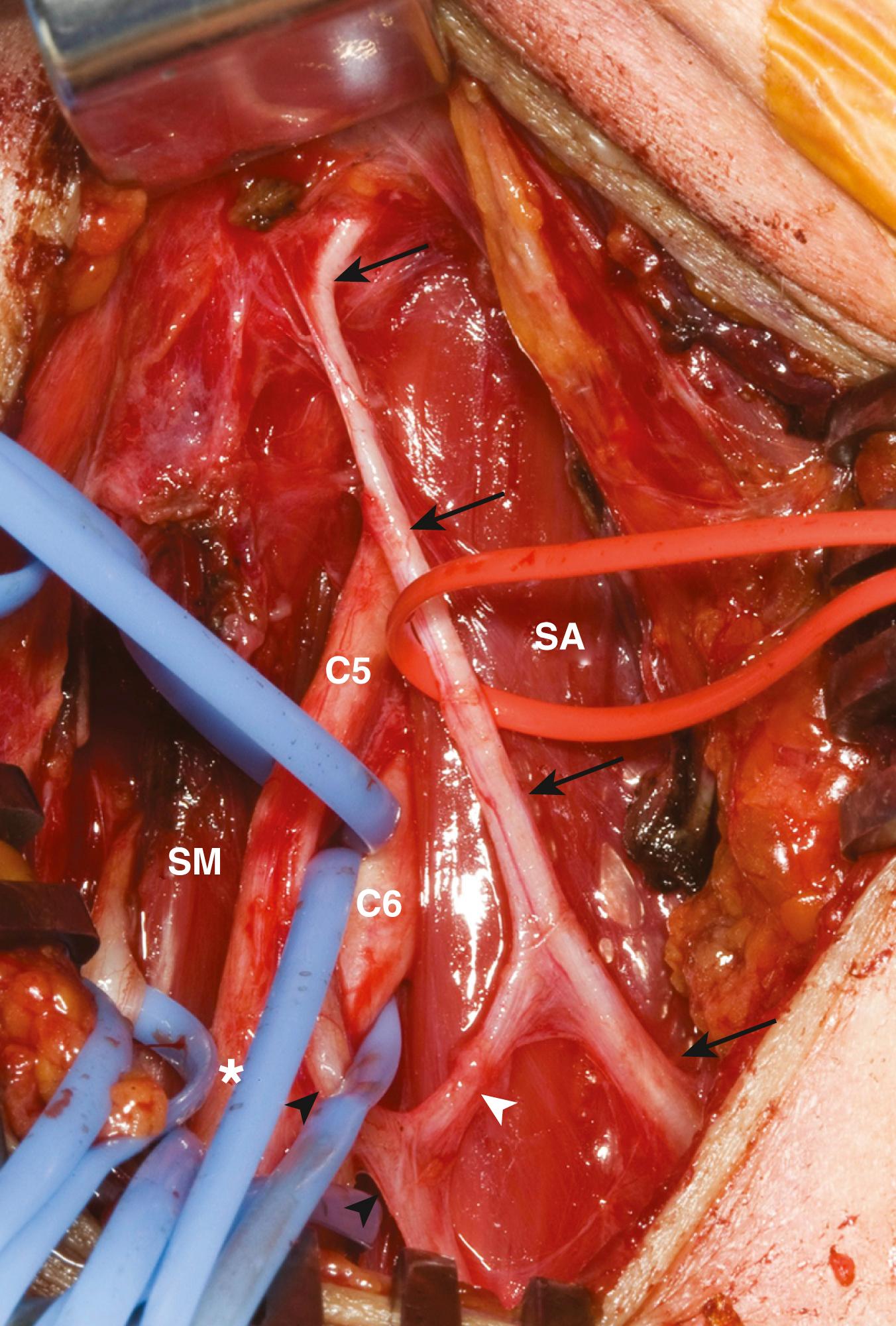 FIGURE 185.1, Intraoperative photograph. The phrenic nerve (black arrows) can be seen crossing from lateral to medial over the scalenus anterior (SA). The C5, C6 nerves, and the upper trunk (asterisk) pass behind and lateral to this muscle but anterior to the scalenus medius (SM). The nerve to subclavius (black arrowheads) and the accessory phrenic nerve (white arrowhead) are also depicted.