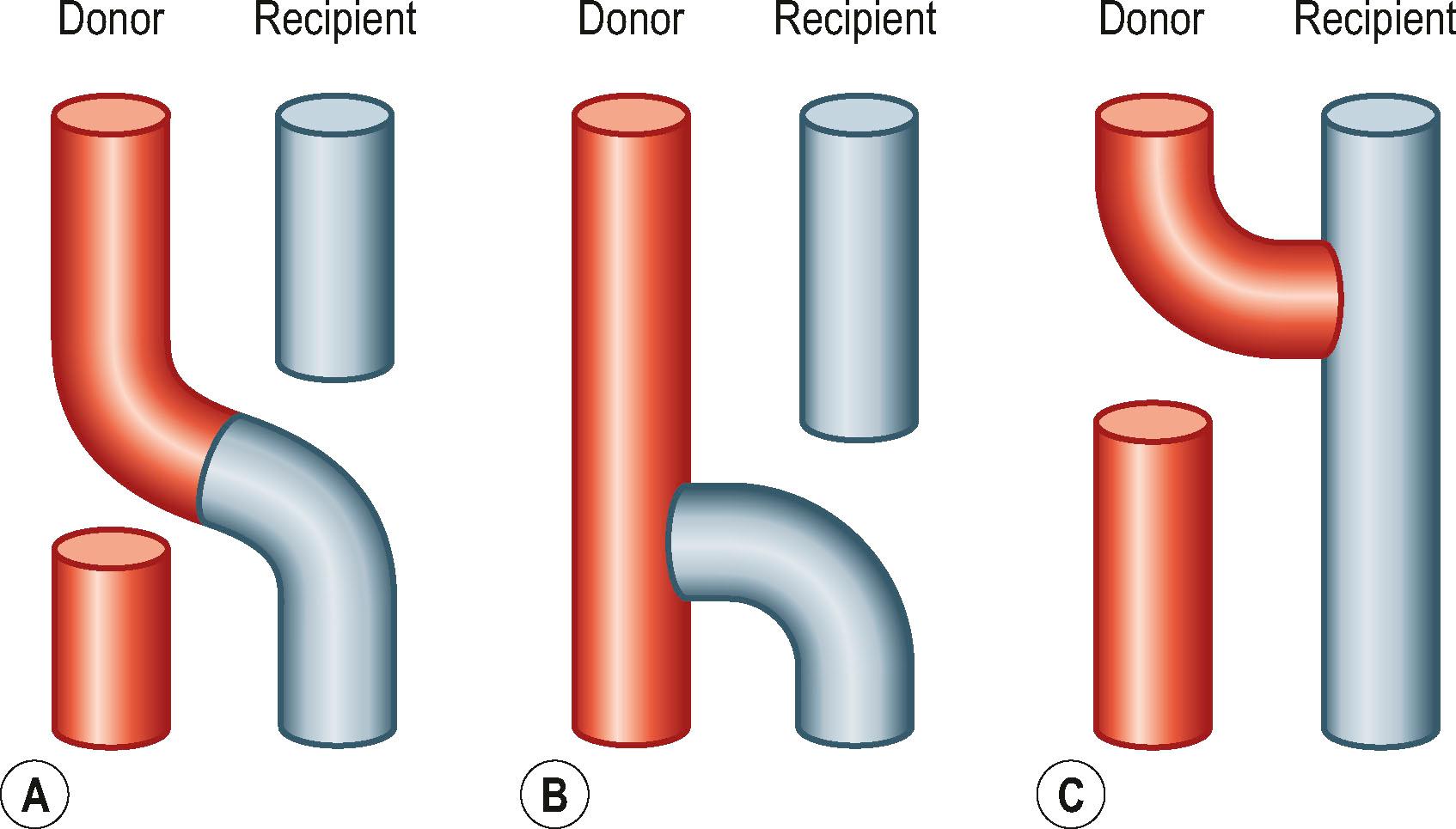 Figure 26.1, The various options for coaptation in nerve transfer. (A) End-to-end coaptation between the donor nerve (red) and the recipient nerve (blue). (B) End-to-side coaptation, where the distal end of the divided recipient nerve (blue) is transferred to the side of the intact donor nerve (red). In this transfer, fascicles from the donor will “sprout” into the distal donor nerve. The recipient nerve essentially “pulls” the donor fascicles into the distal nerve. (C) Supercharge end-to-side coaptation. In this transfer, the donor nerve (red) has been divided and transferred to the side of the intact recipient nerve (blue). The donor essentially “pushes” regenerating fascicles into the distal donor nerve.