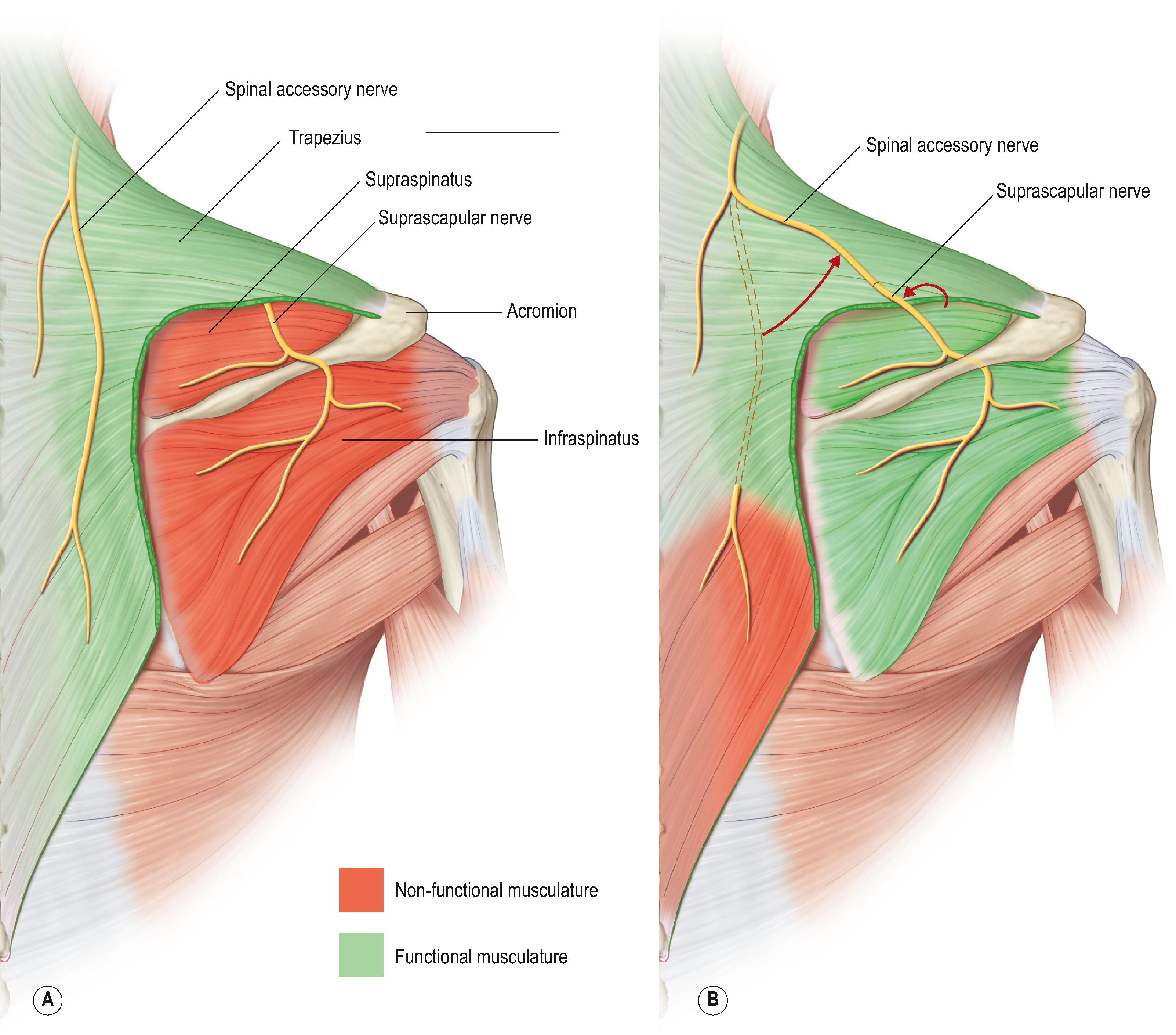 Figure 26.4, The posterior approach for spinal accessory to suprascapular nerve transfers. (A) The nerves can be seen in their original orientation. (B) The end-to-end transfer has been completed. The transfer includes the functional spinal accessory nerve (donor) being transposed and coapted to the non-functional suprascapular nerve (recipient).