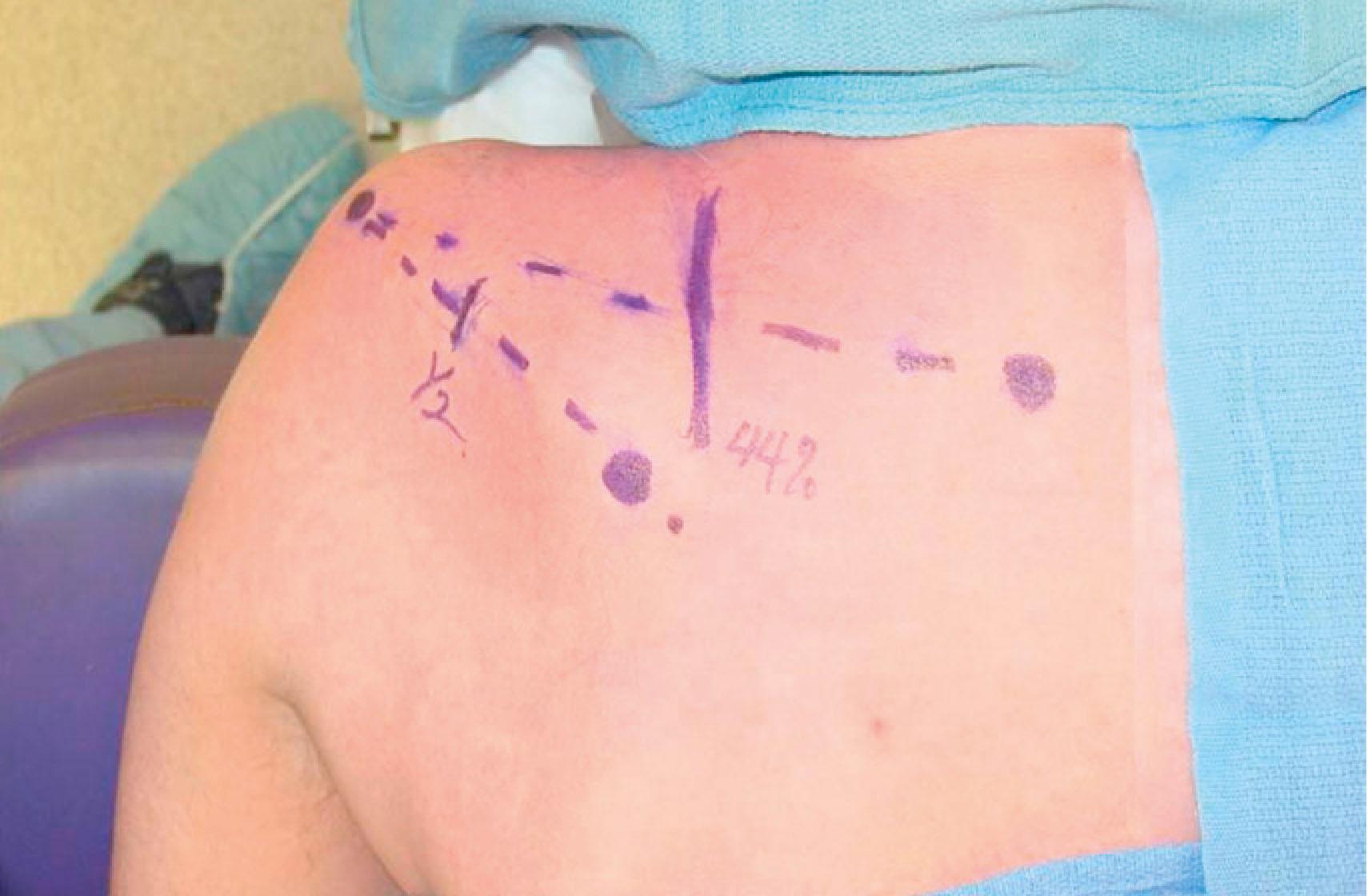 Figure 26.5, Surface markings for posterior approach to spinal accessory to suprascapular. The spinal accessory nerve is located 44% of the way along a line connecting the dorsal midline to the acromion. The suprascapular nerve is located at the halfway point between the medial border of the scapula and the acromion on an obliquely oriented line at the superior aspect of the scapular spine. It runs in the suprascapular notch.