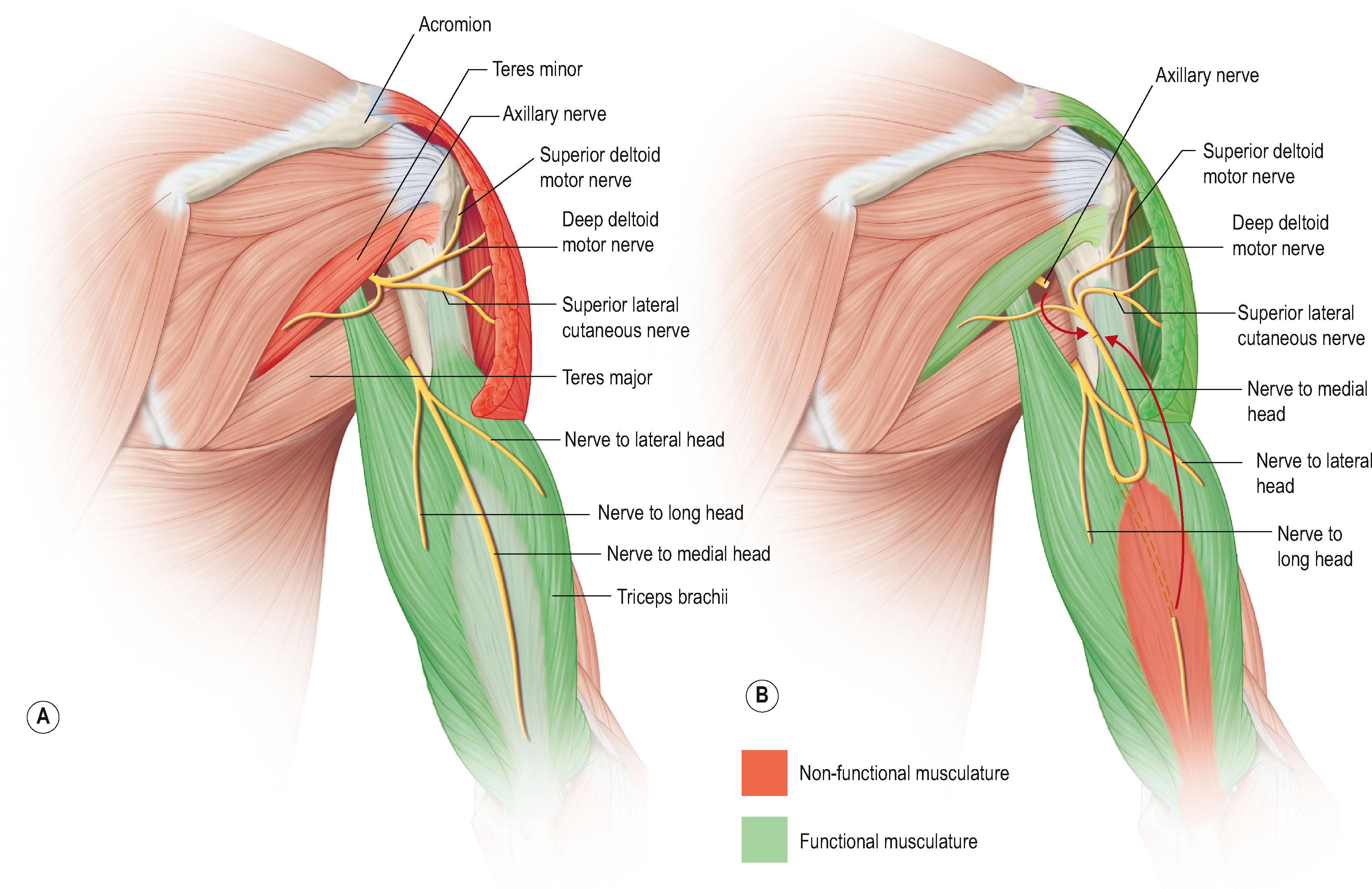 Figure 26.6, The triceps to axillary nerve transfer via a posterior approach to the upper arm. (A) The axillary and radial nerves in their normal anatomical position. (B) The branch to the medial head of the triceps (donor) is transposed to meet the divided end of the axillary nerve (recipient). The branch to the medial head is coapted end to end to the axillary nerve.