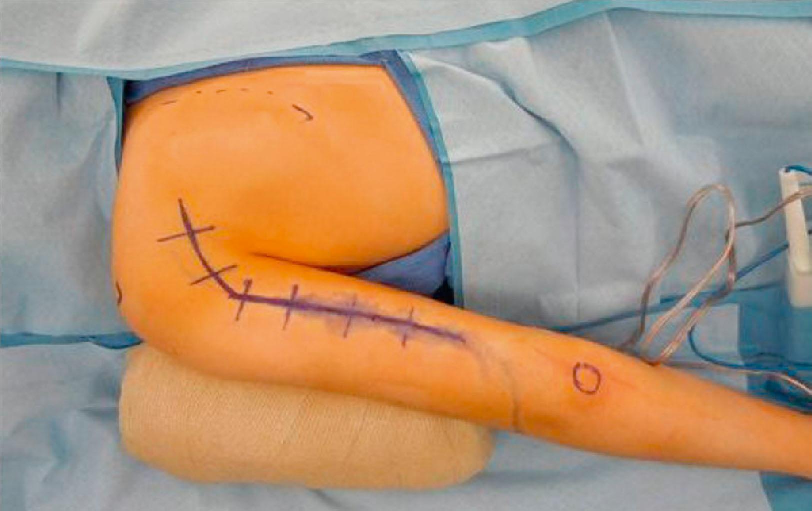 Figure 26.7, Set-up and incision for triceps to axillary. The patient is positioned in the prone position and draped with the entire extremity free and the medial border of the scapula exposed. A line connecting the olecranon and the acromion is drawn on the posterior aspect of the arm and then extended in a curvilinear fashion just above the posterior axillary fold. Positioning is facilitated by placing a “bump” beneath the anterior shoulder preventing internal rotation and anterior subluxation. The arm is draped free so that distal function can be assessed with intraoperative nerve stimulation.