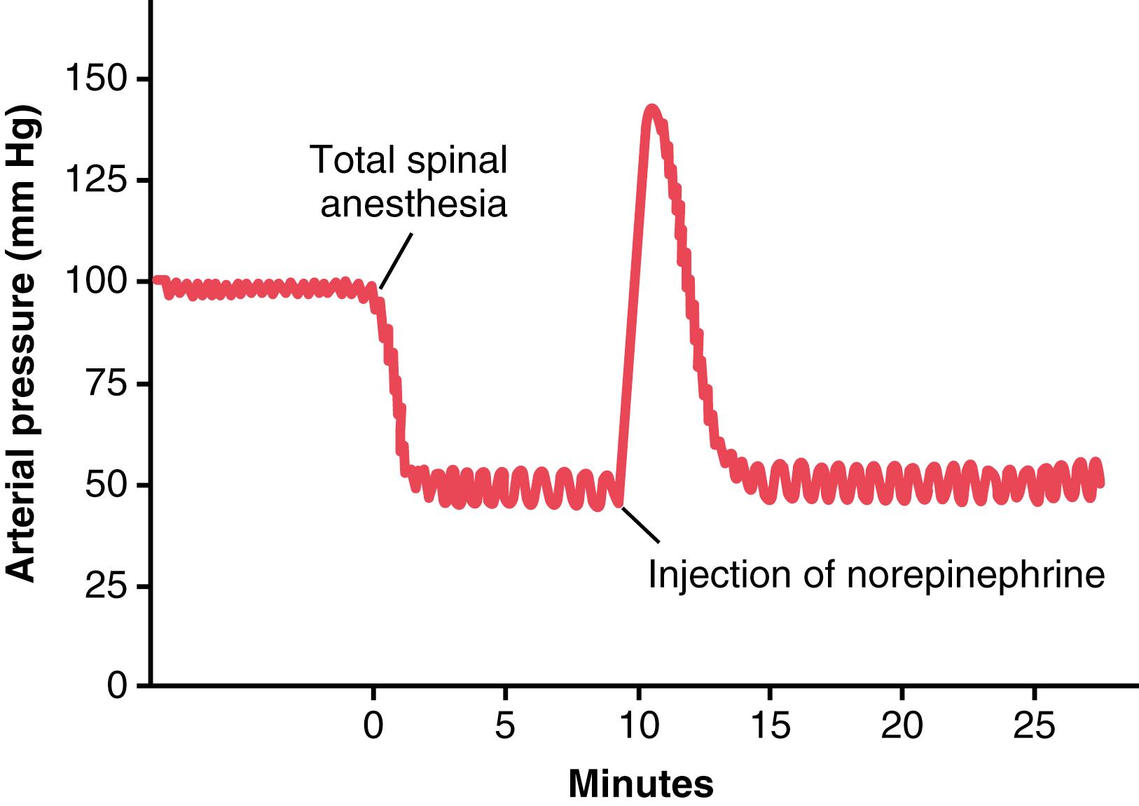 Figure 18-4., Effect of total spinal anesthesia on the arterial pressure, showing a marked decrease in pressure resulting from loss of vasomotor tone.