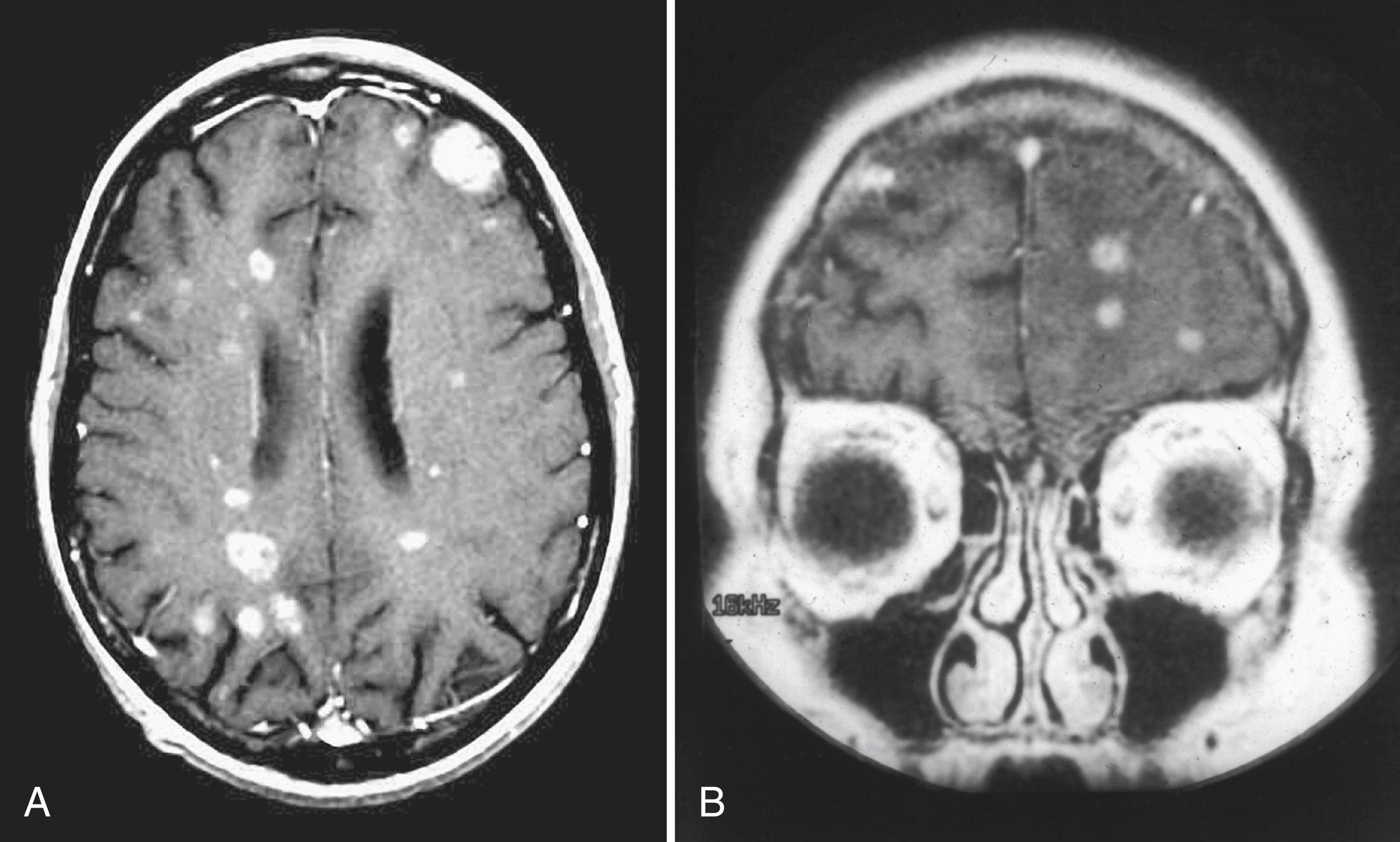 Fig. 76.1, (A) Axial and (B) coronal T1-weighted, contrast-enhanced magnetic resonance image of the brain of a 58-year-old woman with breast cancer treated 1 year previously with whole-brain radiation therapy for brain metastases, who presents with multiple recurrent lesions. Treatment options are limited to chemotherapy or re-irradiation.