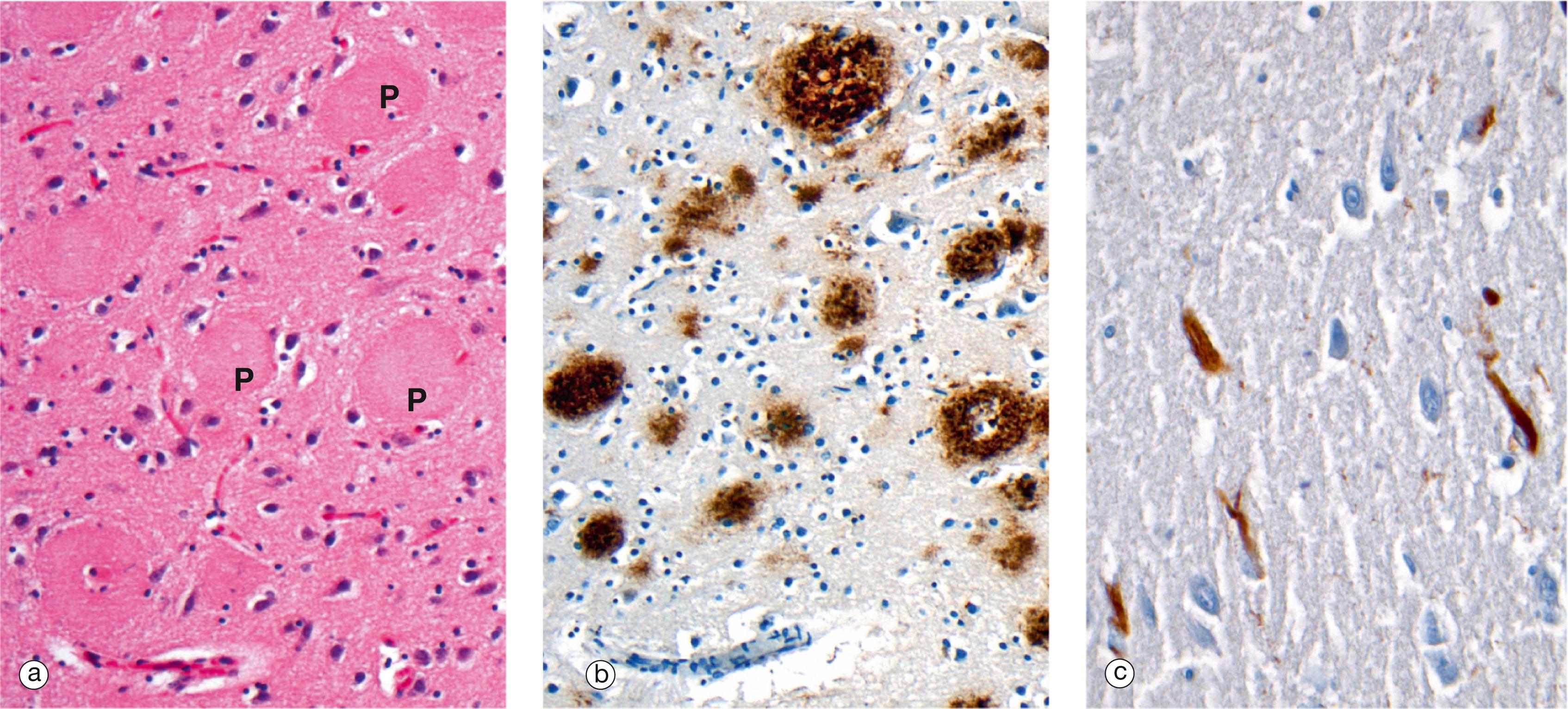 E-Fig. 7.1, Alzheimer’s disease