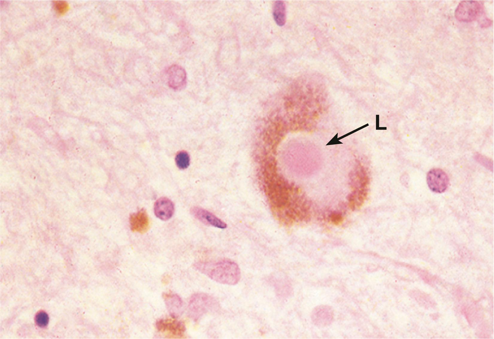 E-Fig. 7.2, Parkinson’s disease (HP)