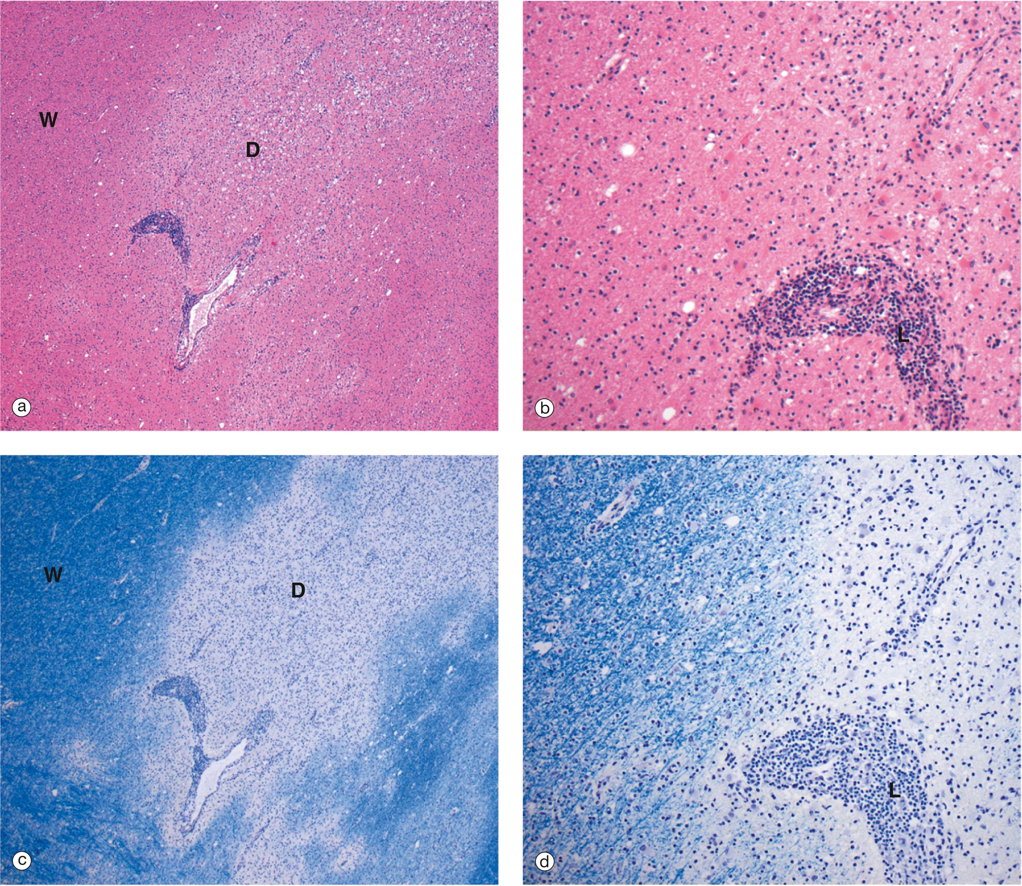 E-Fig. 7.3, Multiple sclerosis