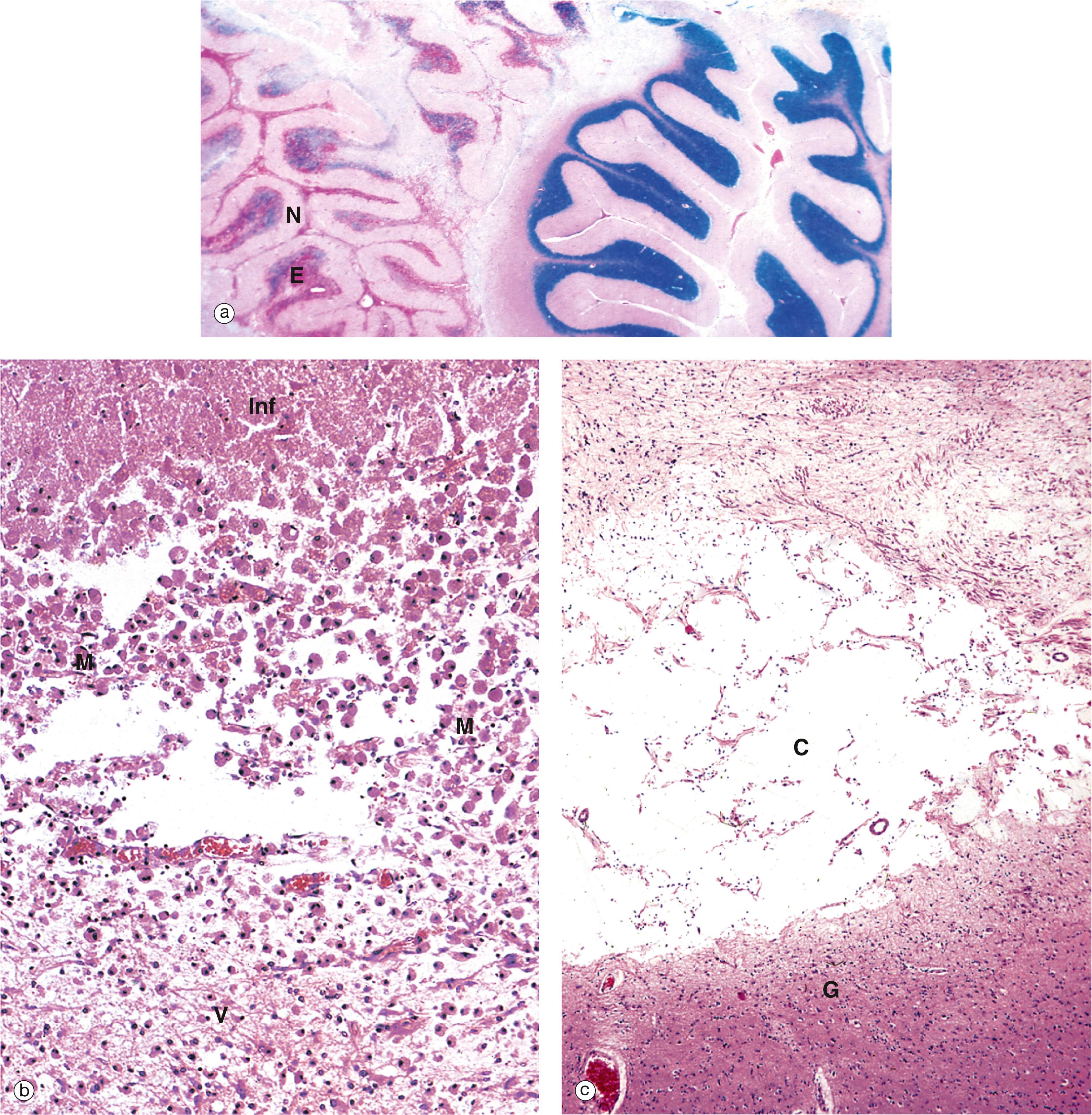 E-Fig. 7.4, Infarction