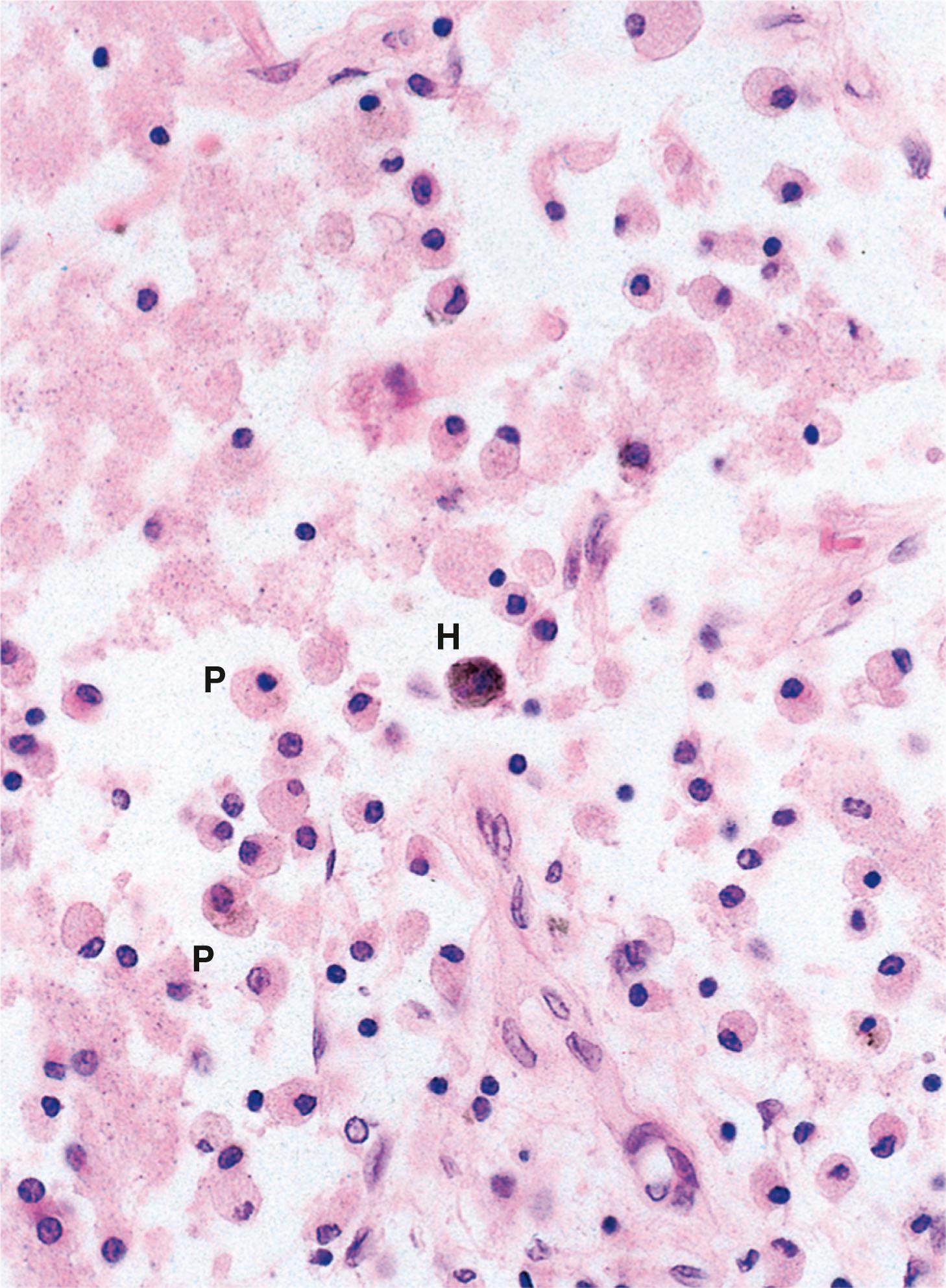 E-Fig. 7.5, Colliquative necrosis of brain (HP)