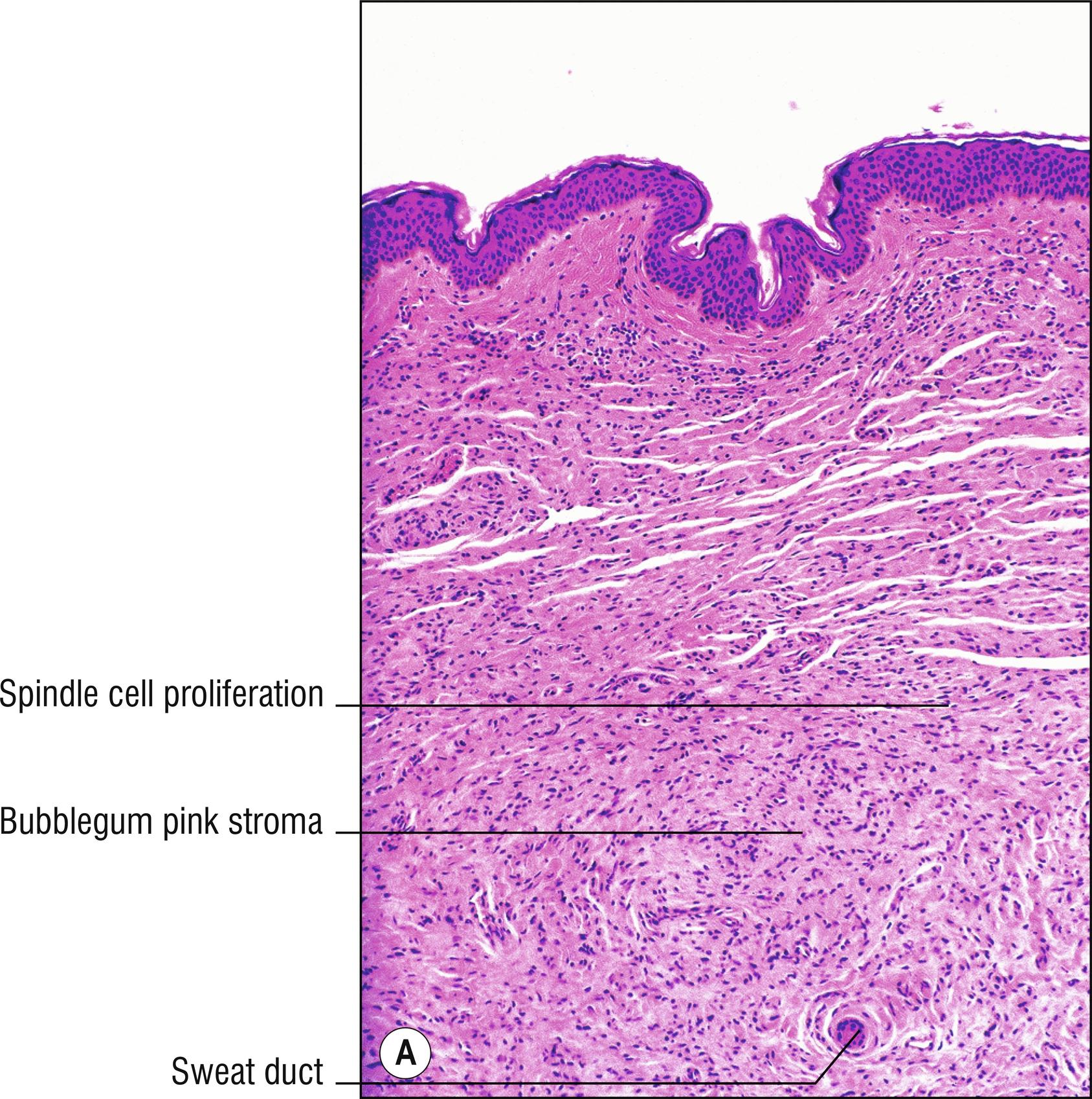 Fig. 26.1, A Neurofibroma (low mag.).