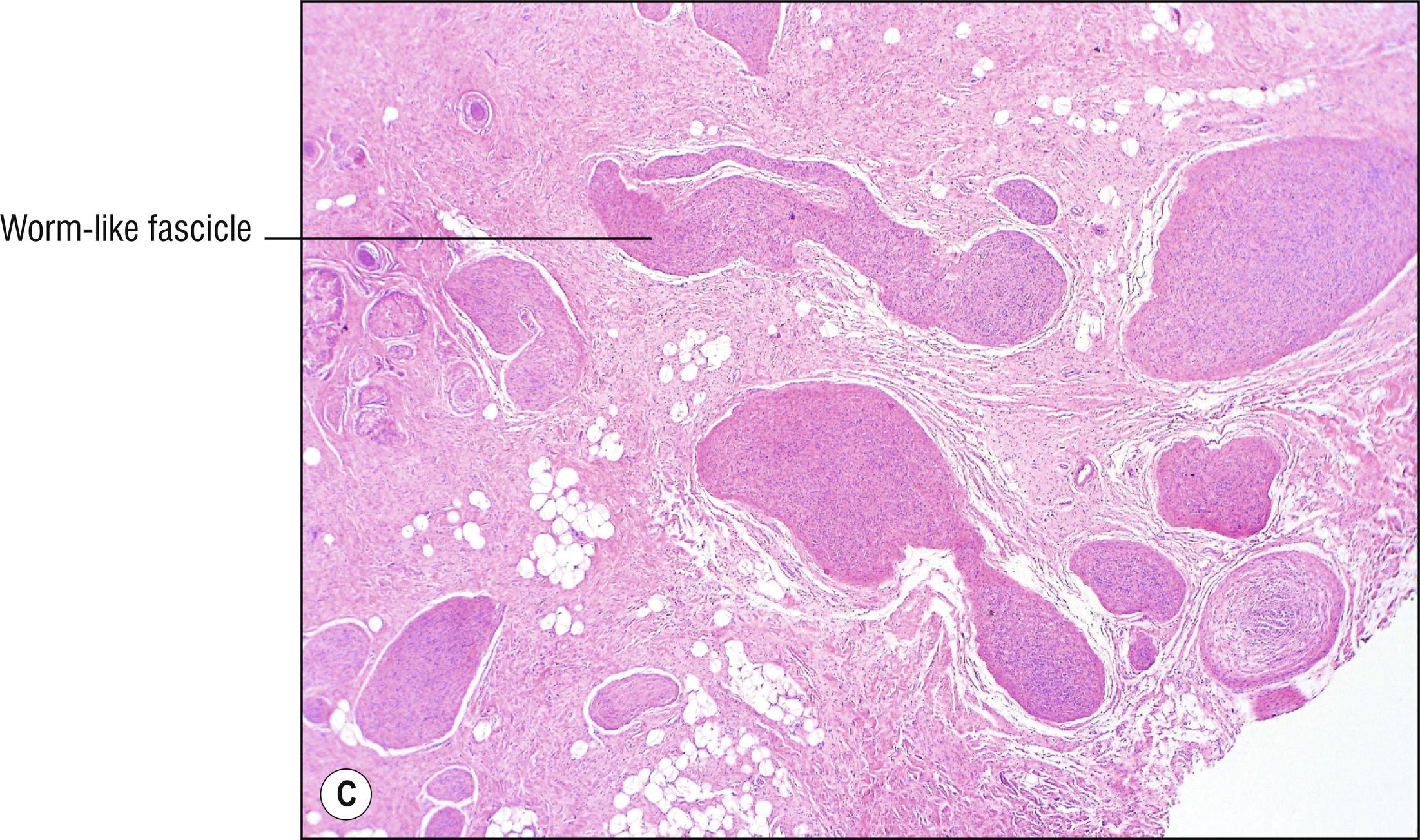 Fig. 26.1, C Plexiform neurofibroma.