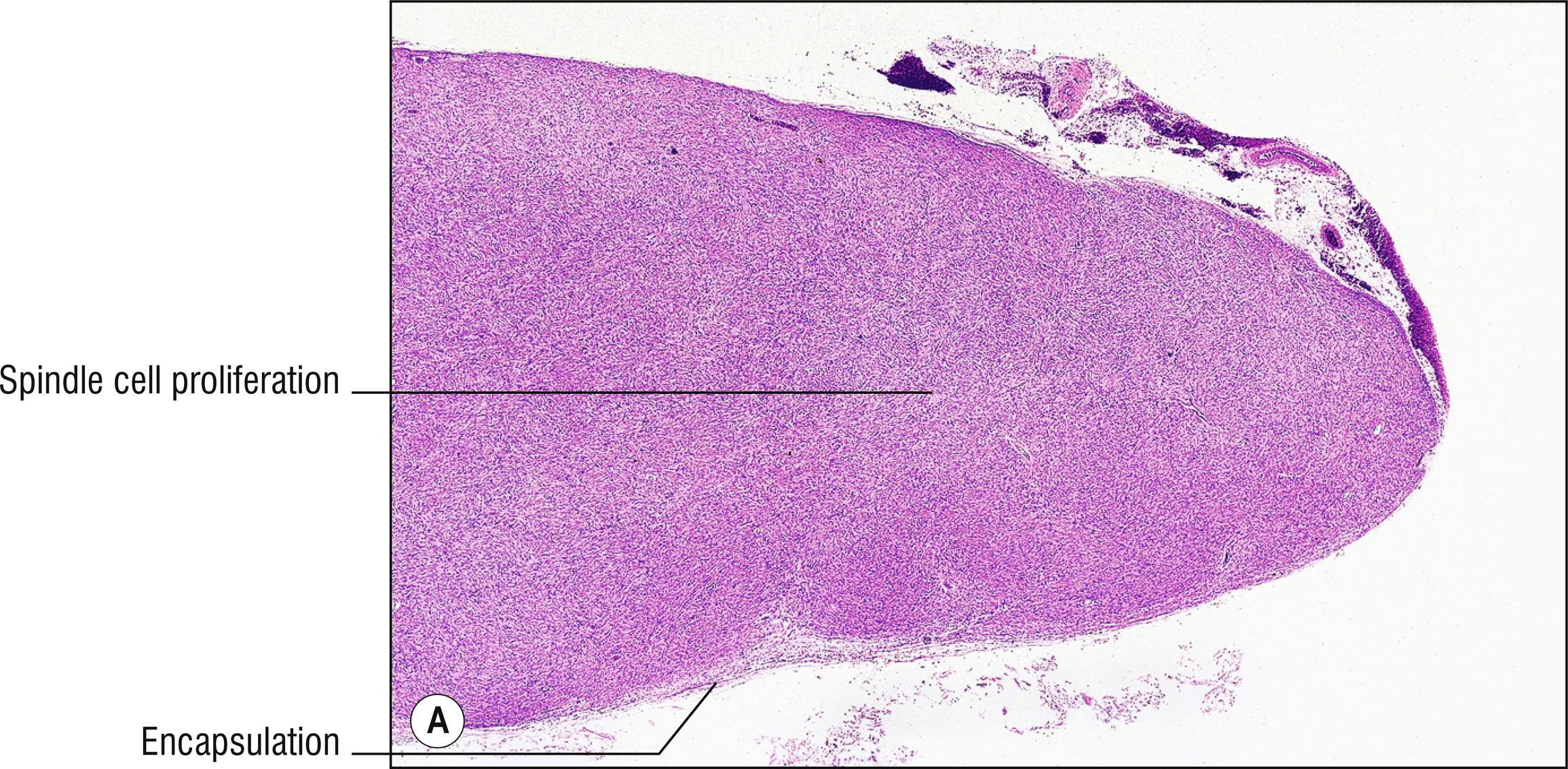 Fig. 26.2, A Schwannoma (low mag.).