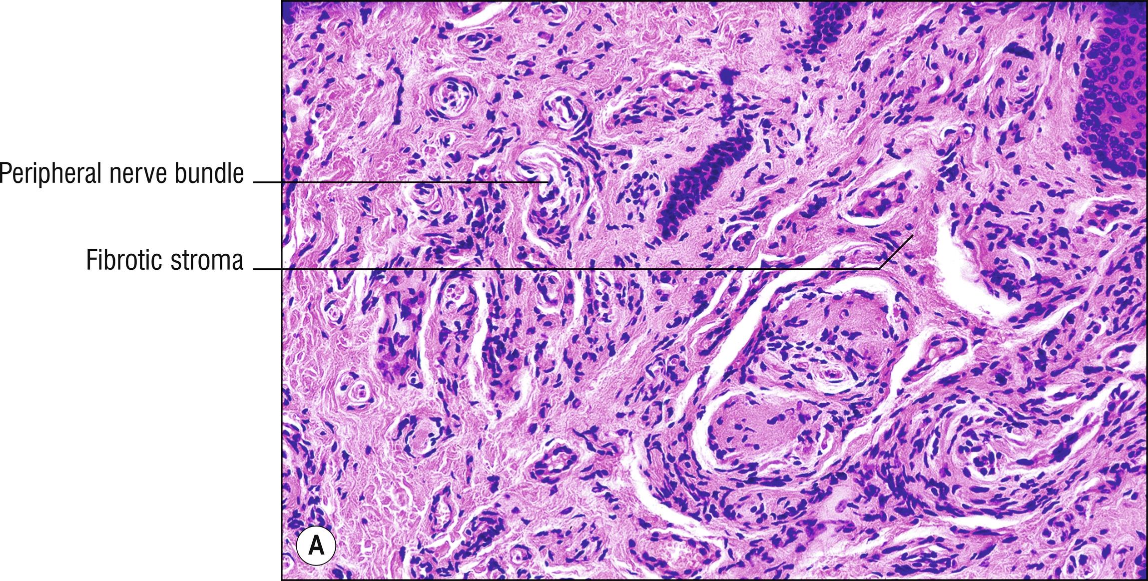 Fig. 26.3, A Traumatic neuroma.