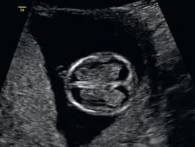 Fig. 41.1, Normal fetal head at 12 weeks of gestation: normal ossification of the skull, two hemispheres, both choroid plexus and the falx cerebri are visible.