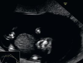 Fig. 41.2, Anencephaly at 13 weeks of gestation: coronal plane showing the absent calvarium.