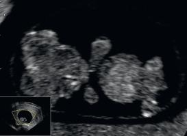 Fig. 41.6, Exencephaly at 9 weeks: the coronal plane shows the “Mickey Mouse” sign.