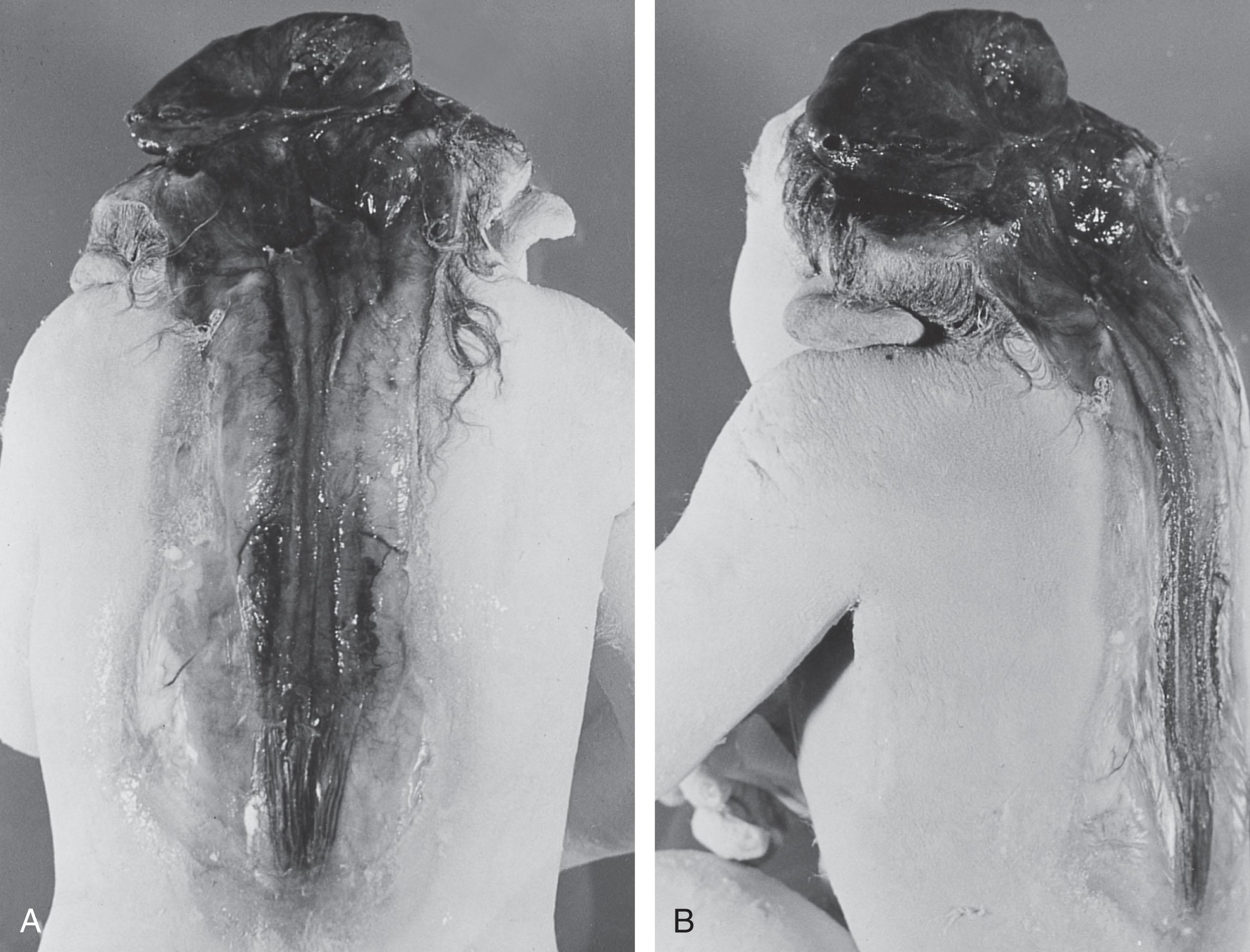 Fig. 1.2, Craniorachischisis. Dorsal (A) and dorsolateral (B) views of a human fetus.