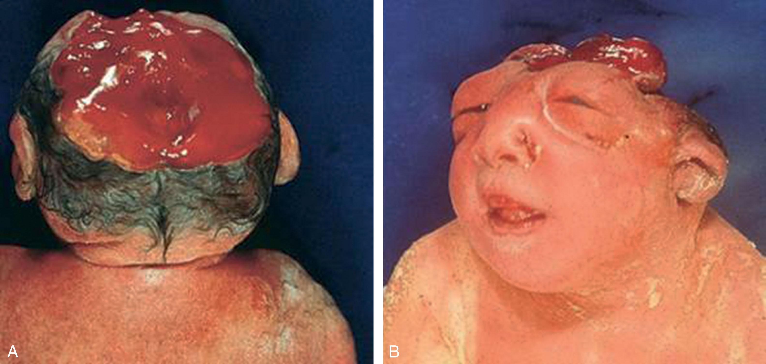 Fig. 1.3, Anencephaly. Dorsal (A) and frontal (B) views. Note the absence of scalp, calvarium, and almost the entire brain, with the characteristic facies, including absent forehead, giving the eyes an appearance of bulging. The lack of cranial bones causes the cranial cavity to be completely open. There is no discernible brain grossly; however, there is sometimes a small mass of neurovascular tissue (area cerebrovasculosa) in the base of the cranium. Rarely, there can be acrania without anencephaly in which the calvarium is absent but with significant development of brain.