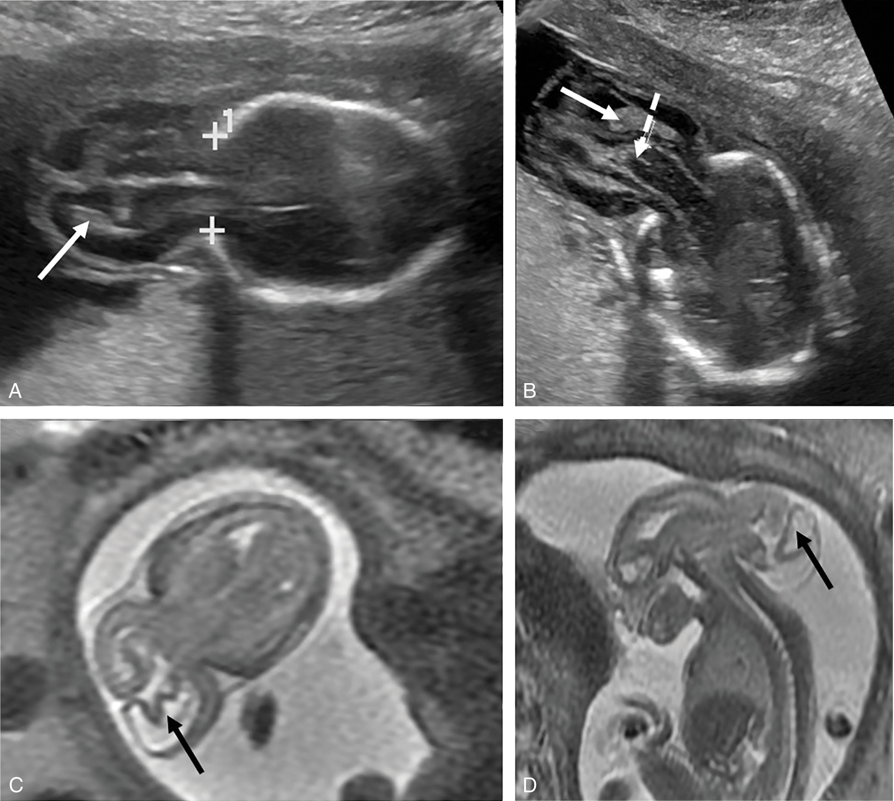 Fig. 1.5, Meningoencephalocystocele. A 22-week gestational age fetus with a large posterior meningoencephalocystocele with herniated occipital, temporal, and parietal lobes; brainstem; cerebellum; and posterior lateral ventricles. Fetal ultrasound (A, B, axial views) and T2-weighted MRI (C, axial view; D, sagittal view). Crosses (A) show cranial defect; white solid arrows (A, B) show choroid plexus; broken white arrow (B) shows herniated brainstem; black arrows (C, D) show lateral ventricles within the herniated brain tissue.