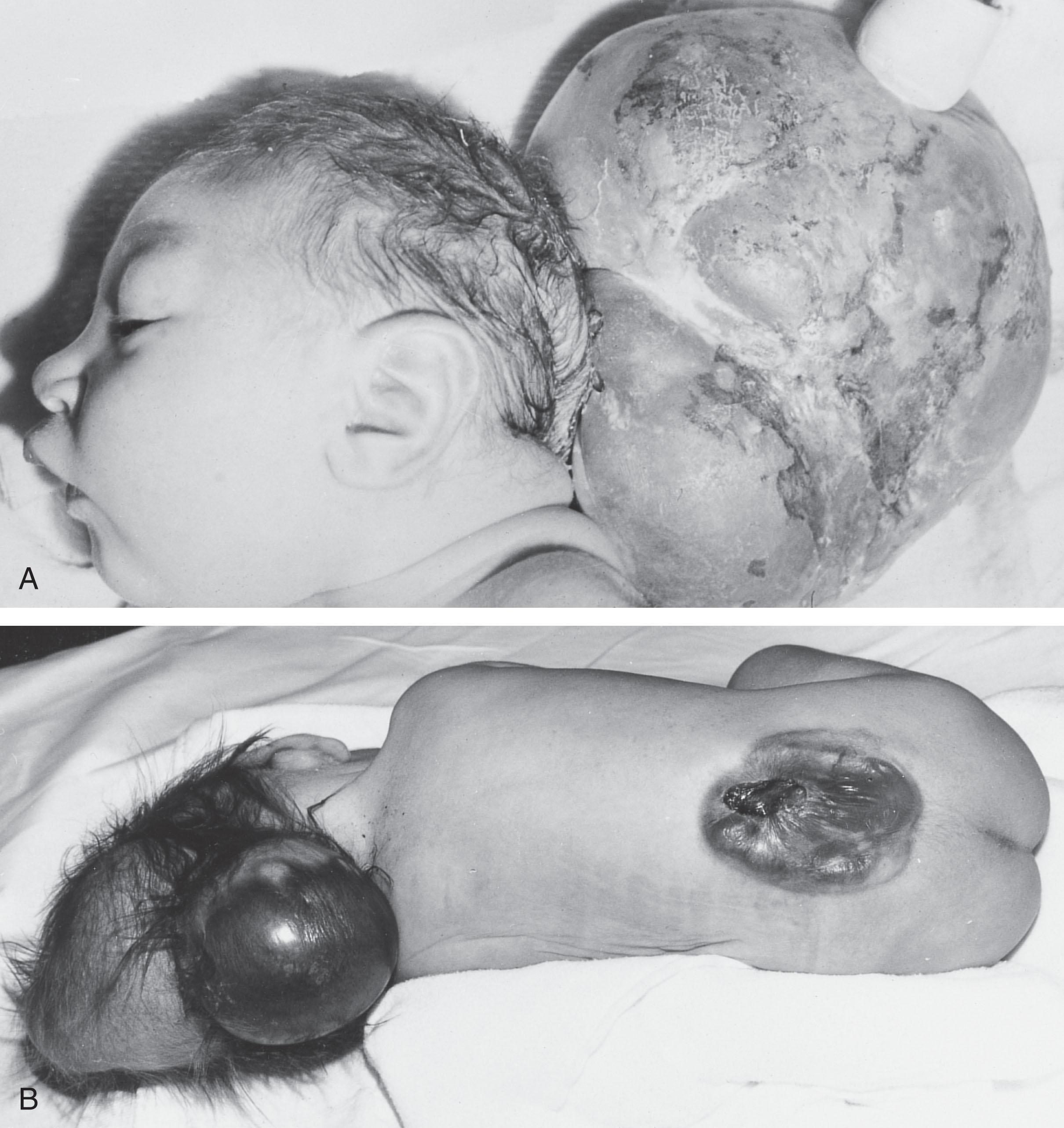 Fig. 1.7, Encephalocele. (A) Newborn with a large occipital encephalocele. (B) Newborn with both an occipital encephalocele and a thoracolumbar myelomeningocele.