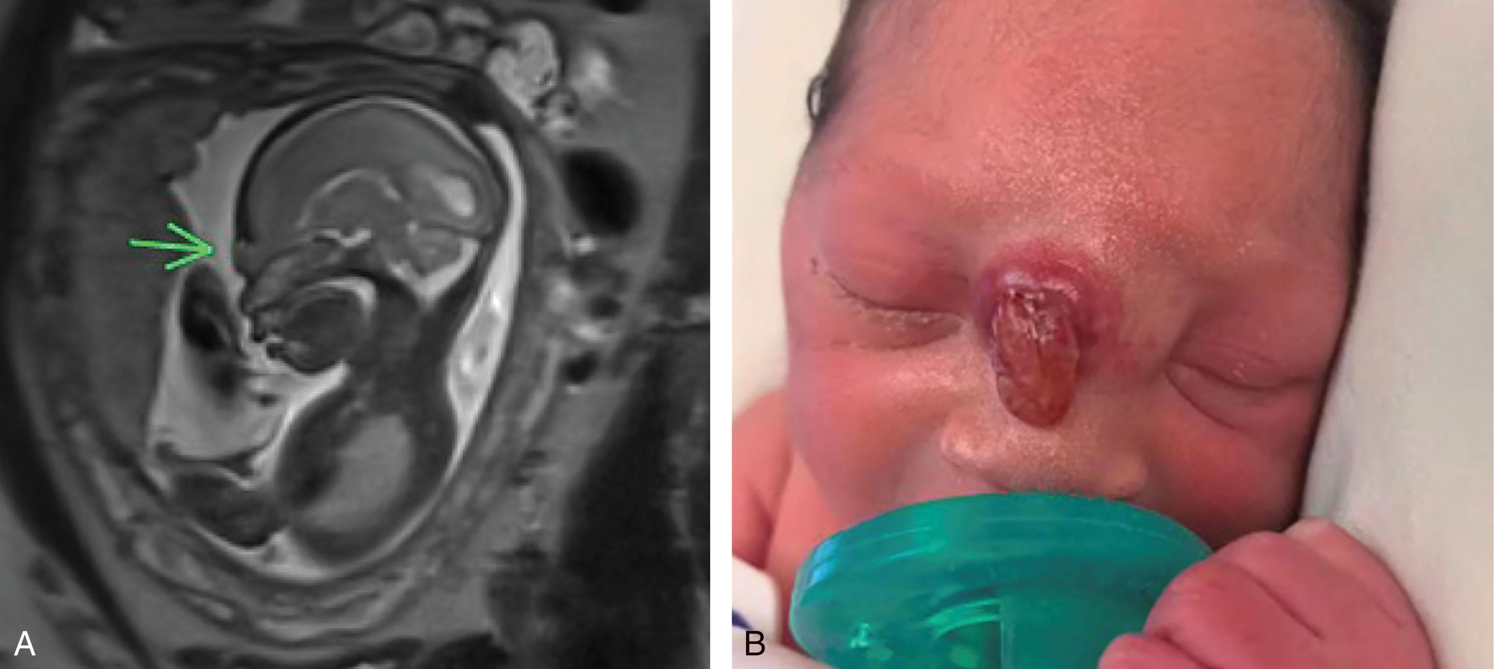 Fig. 1.8, Frontal encephalocele. (A) Sagittal T2-weighted image of 24-week gestational age fetus with a frontal encephalocele ( arrow ). (B) The infant at 2 days of age showing frontal encephalocele prior to surgery.