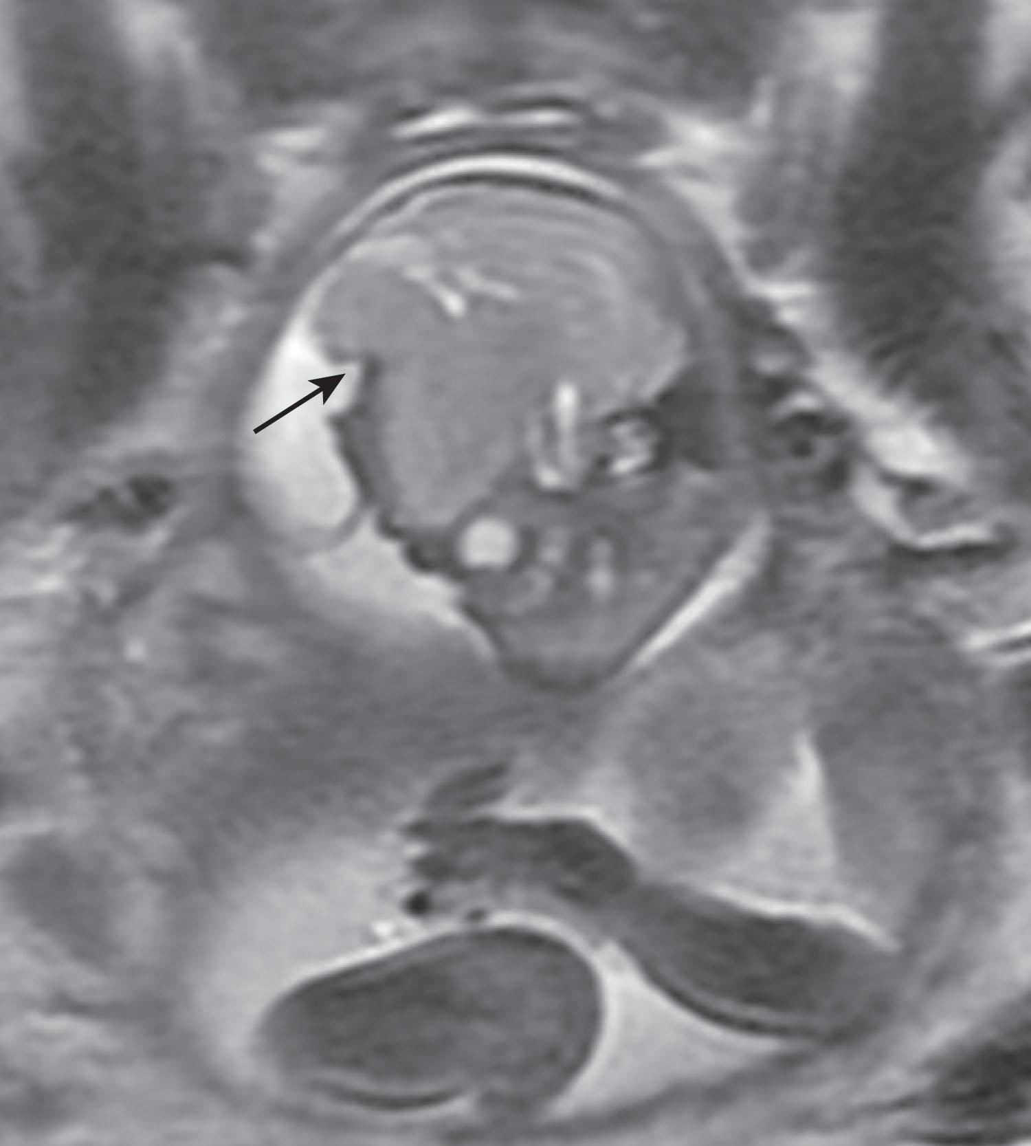 Fig. 1.9, Frontoparietal encephalocele. Fetal MRI (T2-weighted) angled sagittal view showing herniation of brain parenchyma through cranial defect ( arrow ).