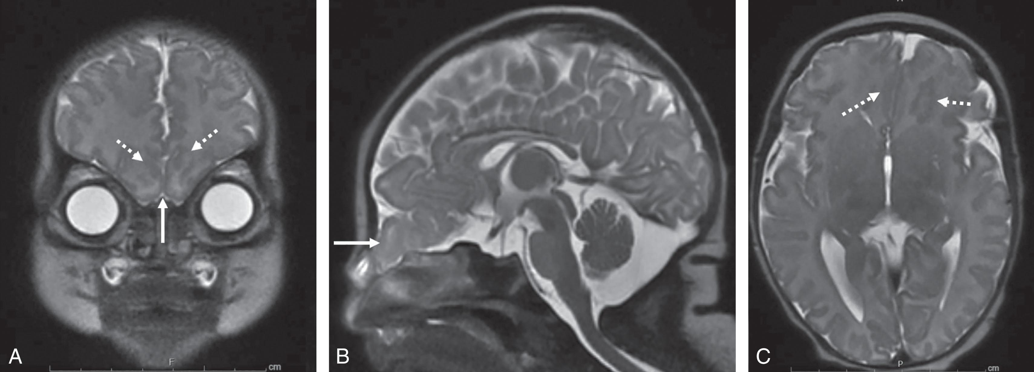 Fig. 1.10, Fronto-ethmoidal encephalocele. T2-weighted images (A, coronal; B, sagittal; C, axial) of a newborn with fronto-ethmoidal encephalocele with herniation of bilateral inferior rectus gyri ( solid arrows , A and B) and bilateral inferior frontal polymicrogyria ( broken arrows , A and C).