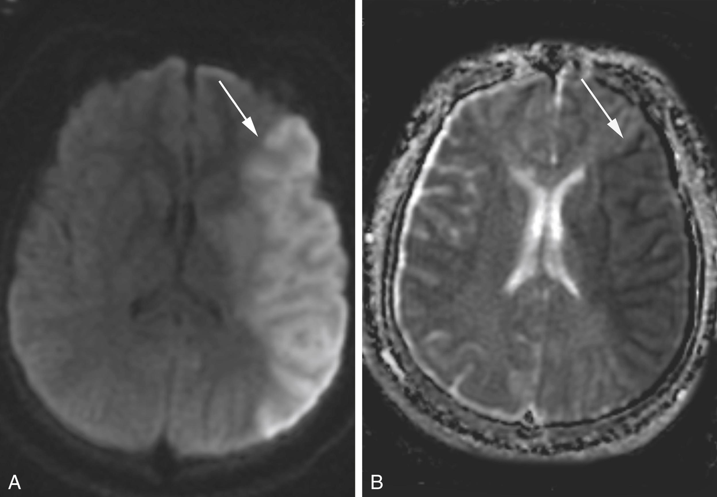 Figure 8-1, Diffusion restriction with left middle cerebral artery stroke.