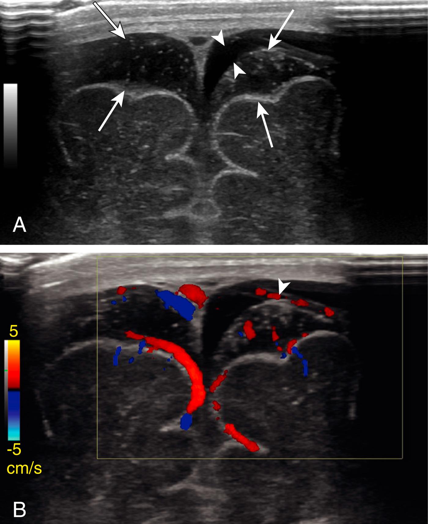 Figure 8-12, Ultrasound of the extraaxial spaces.