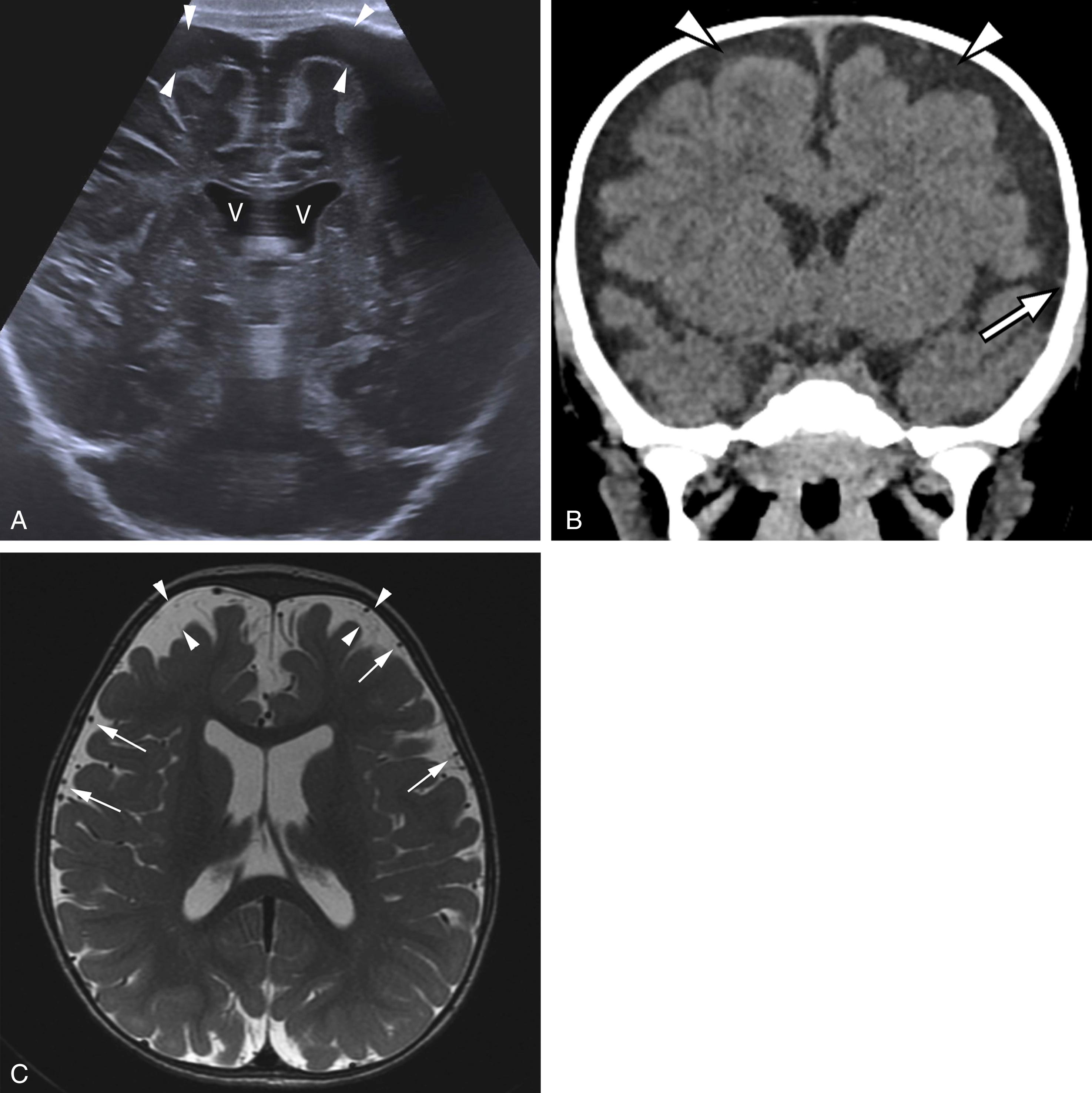 Figure 8-17, Benign enlargement of extraaxial spaces of infancy presenting with a large head circumference.