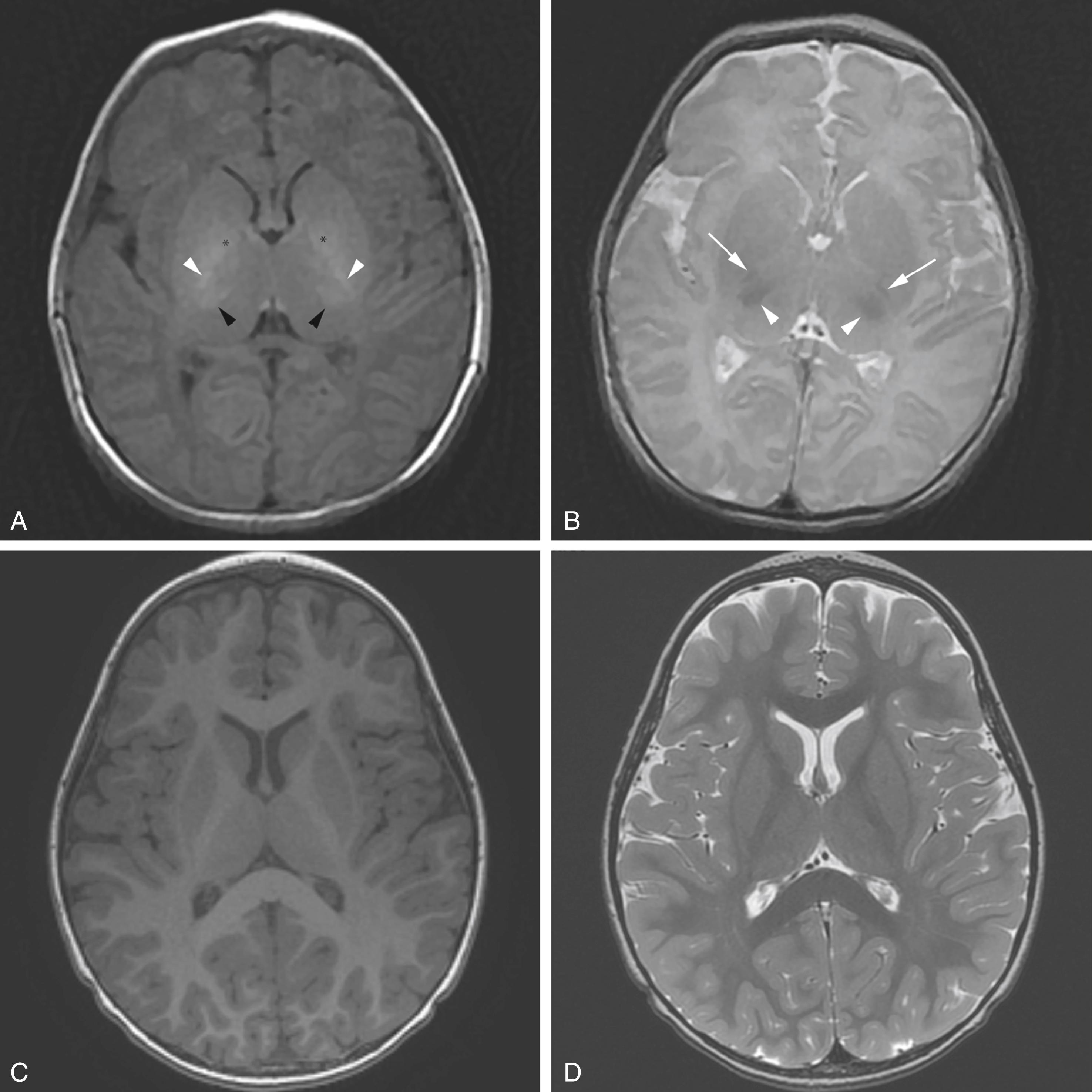 Figure 8-18, Normal brain magnetic resonance imaging at term and 24 Months.