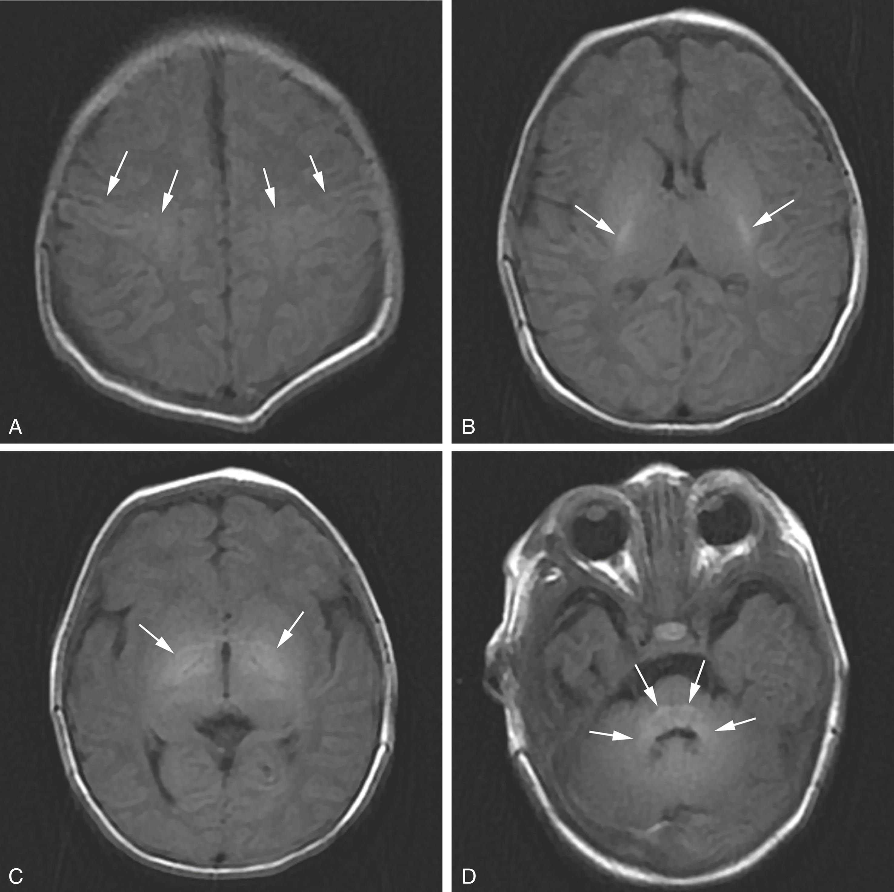 Figure 8-20, Normal pattern of myelination at term.