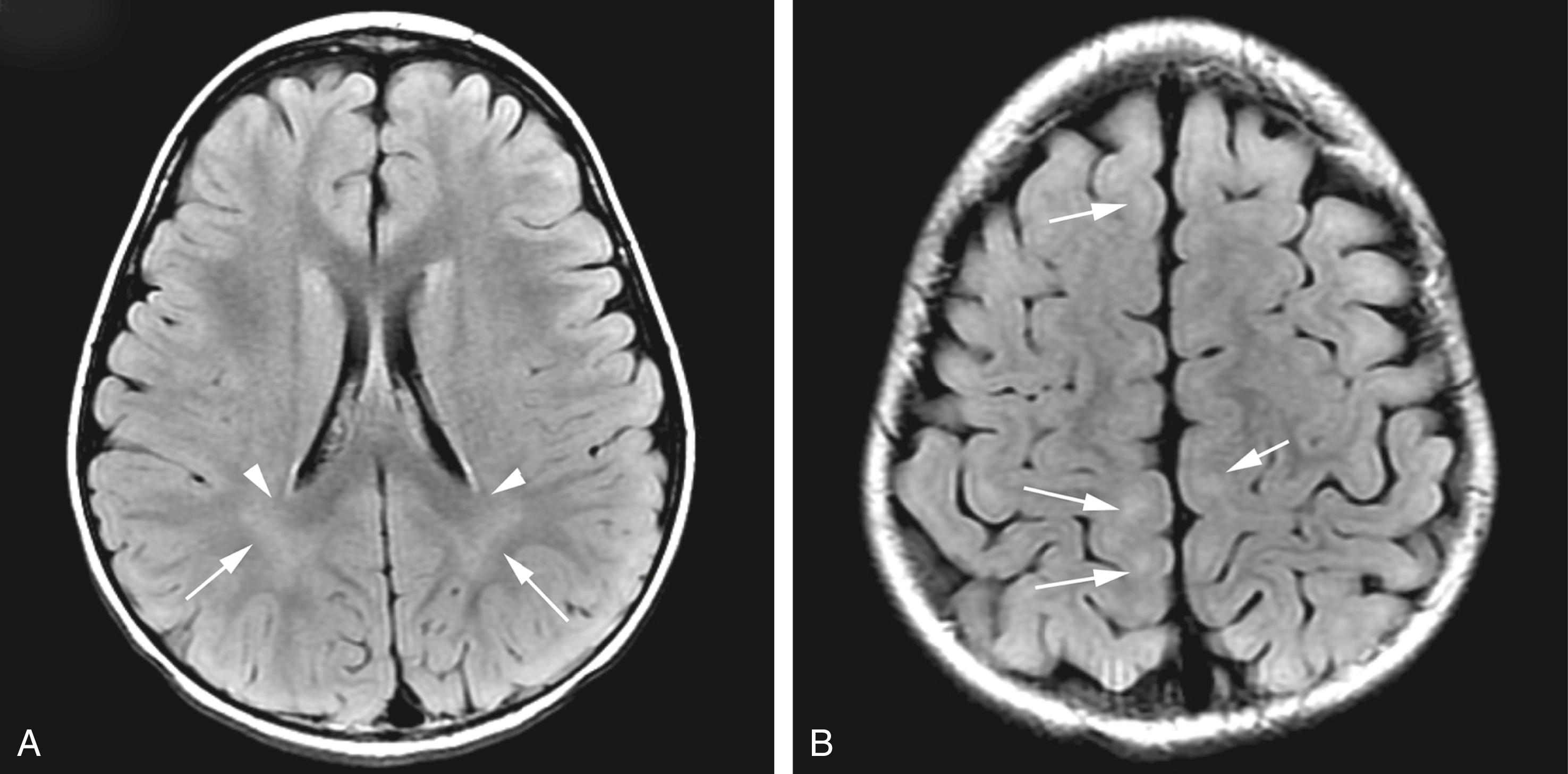 Figure 8-21, Terminal zones of myelination in a normal 40-month-old child.