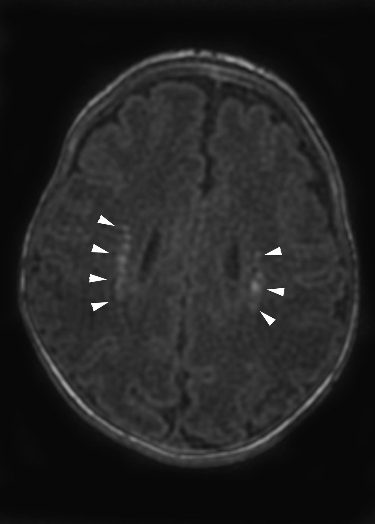 Figure 8-22, Acute, noncavitary white matter injury of prematurity.