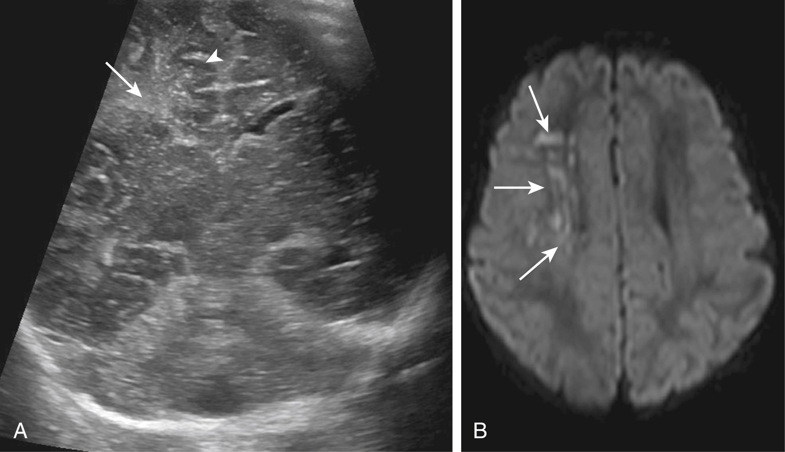 Figure 8-23, Ischemic Insult by Ultrasound.