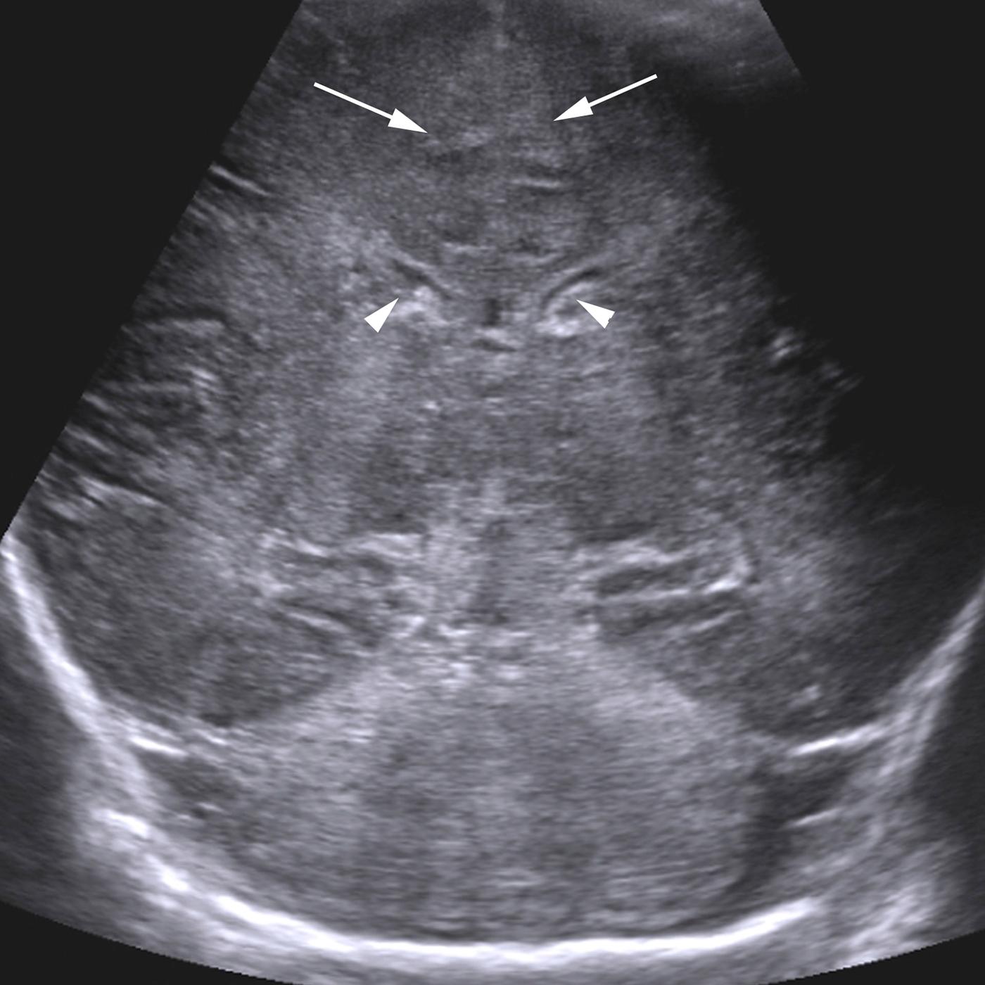 Figure 8-27, Ultrasound findings of hypoxic ischemic insult.