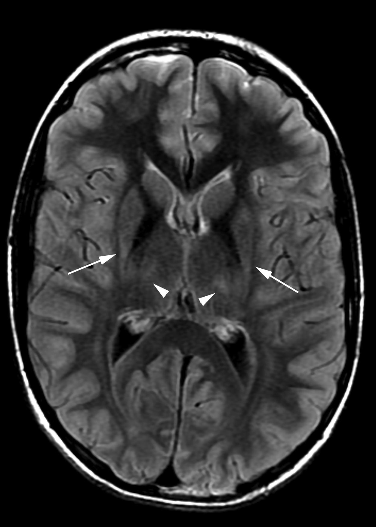 Figure 8-28, Chronic findings of profound hypoxic ischemic insult.