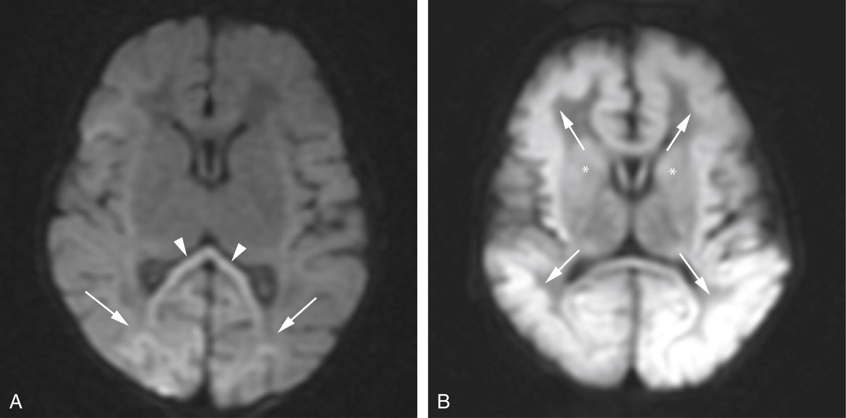 Figure 8-29, Mimickers of neonatal hypoxic ischemic Insult.