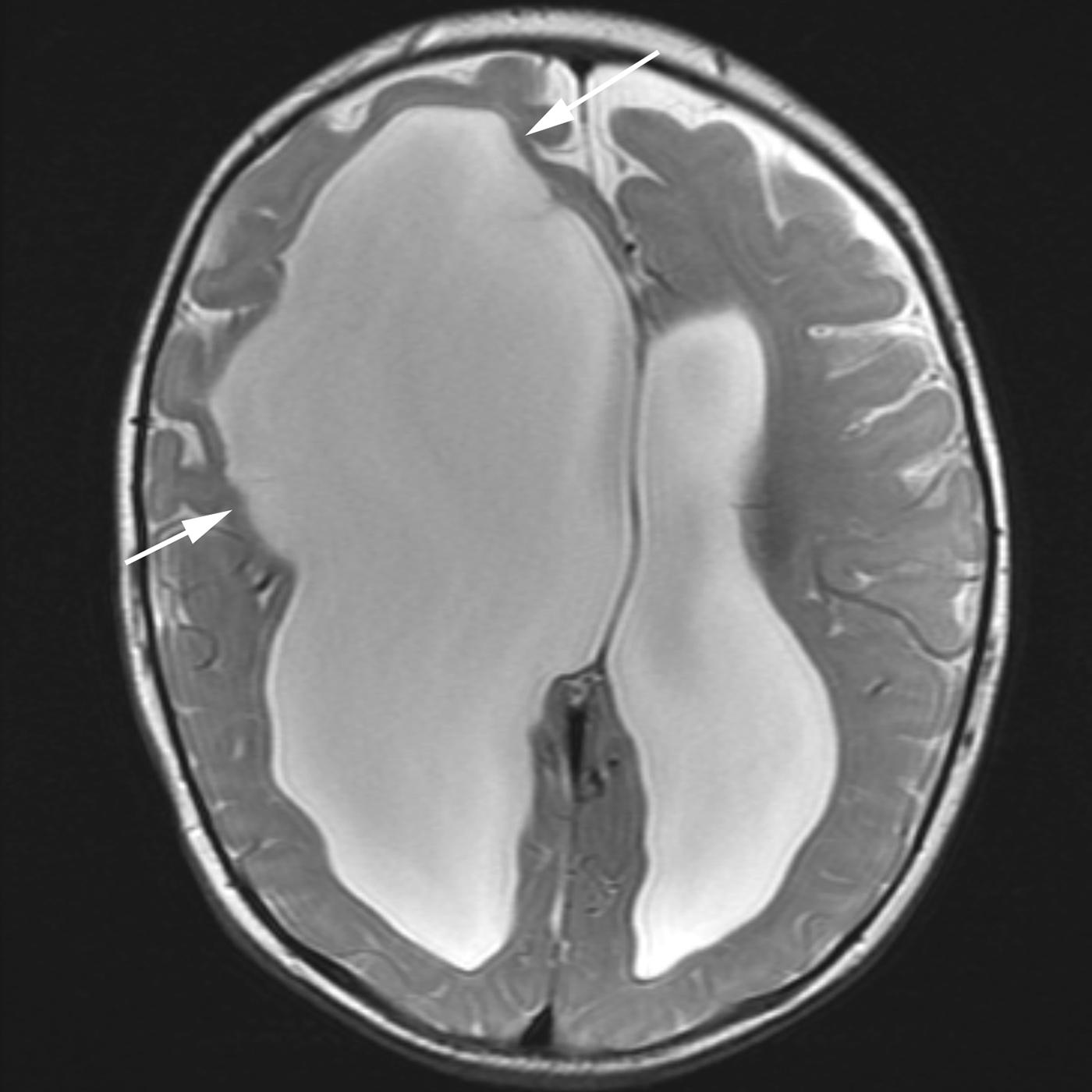 Figure 8-30, Porencephalic cyst shown on axial T2-weighted MRI as a large CSF cyst ( arrows ) that is contiguous with the right lateral ventricle. The communication is not lined by gray matter.