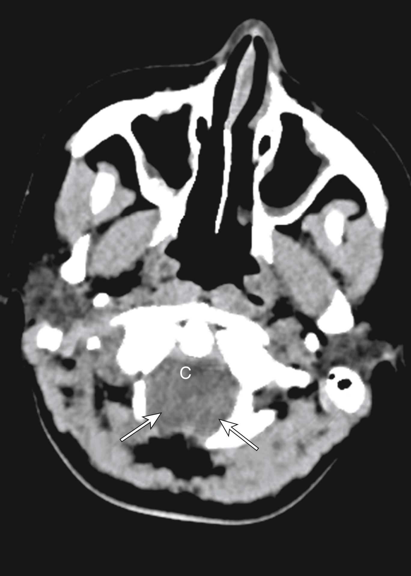 Figure 8-35, Chiari 1.